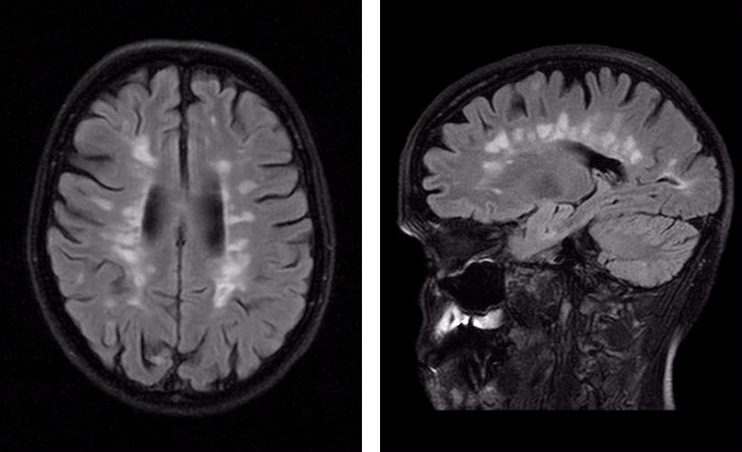 Множественные очаговые изменения мозга